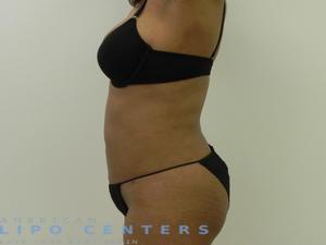 americanlipocenters_169.jpg